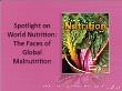 Y khoa, dược - Spotlight on world nutrition: The faces of global malnutrition